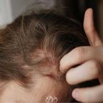 معلومات عن مرض إكزيما الشعر