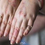 جفاف اليدين الأسباب والعلاج