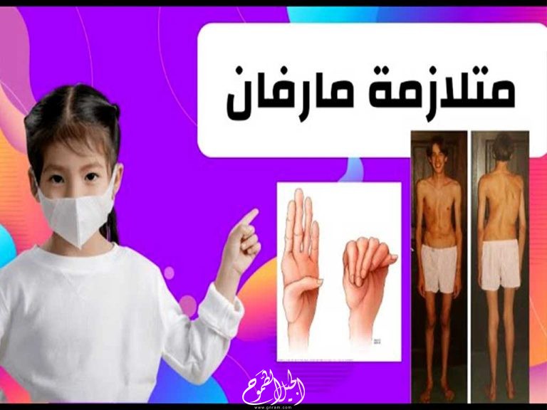 معلومات عن متلازمة مارفان