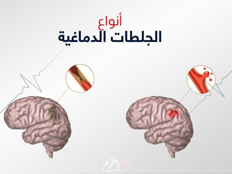 معلومات عن الجلطة