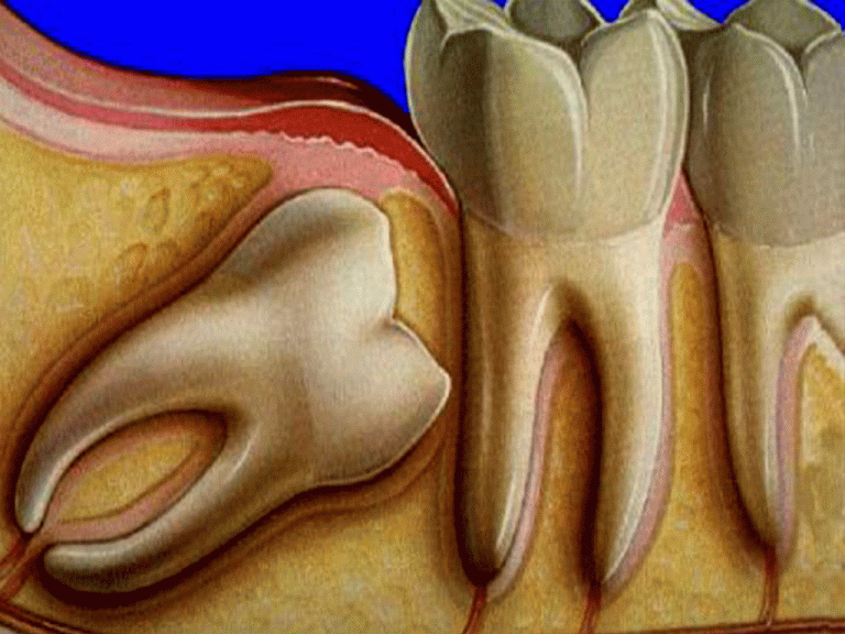 سبب تسمية ضرس العقل بهذا الإسم